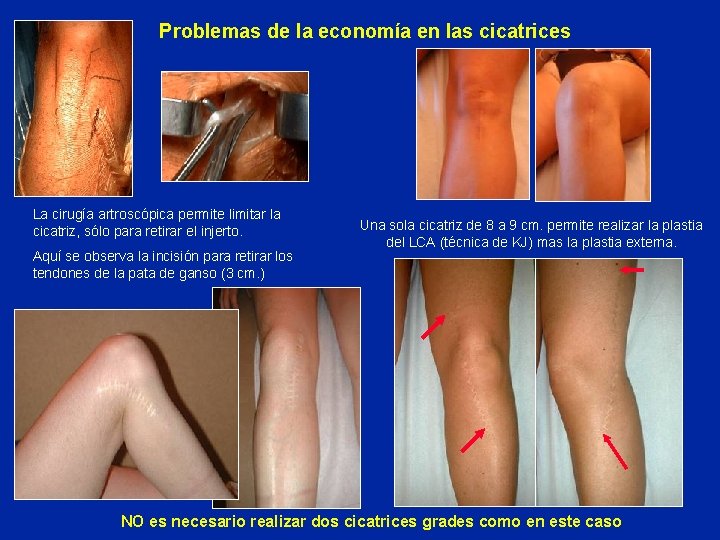 Problemas de la economía en las cicatrices La cirugía artroscópica permite limitar la cicatriz,