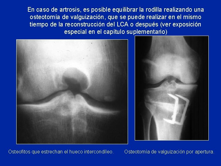 En caso de artrosis, es posible equilibrar la rodilla realizando una osteotomía de valguización,