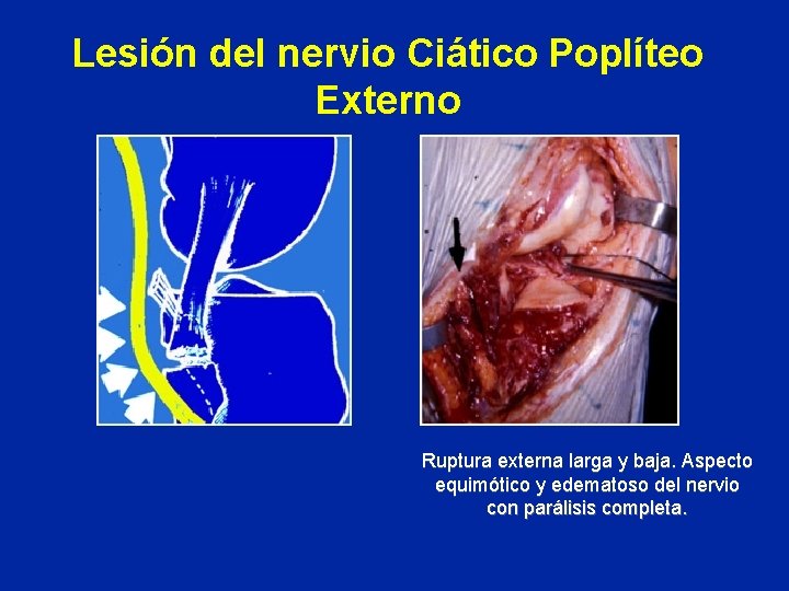 Lesión del nervio Ciático Poplíteo Externo Ruptura externa larga y baja. Aspecto equimótico y