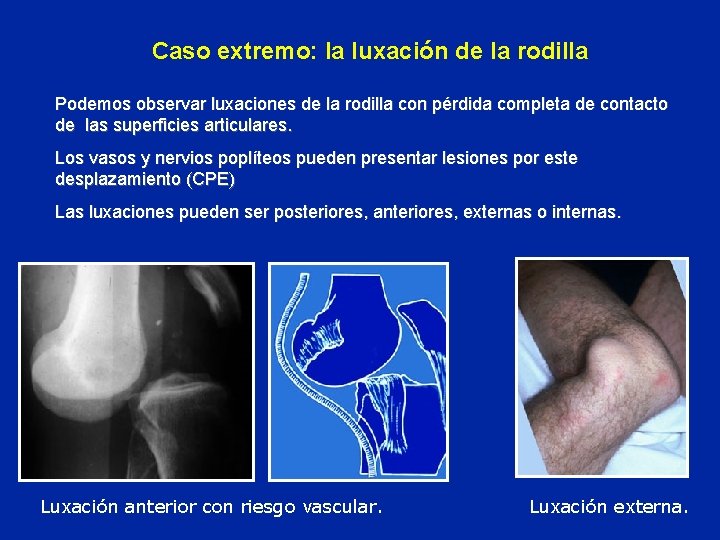 Caso extremo: la luxación de la rodilla Podemos observar luxaciones de la rodilla con