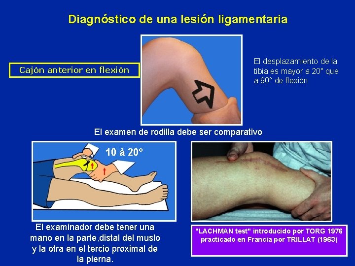 Diagnóstico de una lesión ligamentaria Cajón anterior en flexión El desplazamiento de la tibia