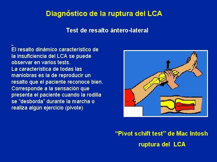 Diagnóstico de la ruptura del LCA Test de resalto ántero-lateral El resalto dinámico característico