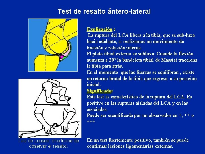  Test de resalto ántero-lateral Explicación : La ruptura del LCA libera a la