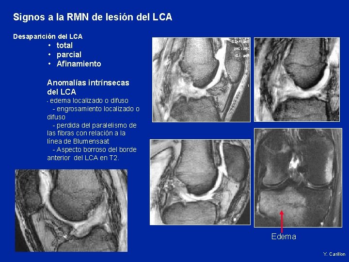 Signos a la RMN de lesión del LCA Desaparición del LCA • total •