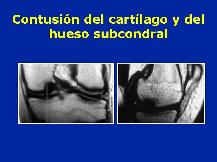 Contusión del cartílago y del hueso subcondral 