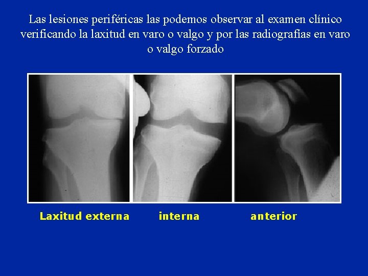 Las lesiones periféricas las podemos observar al examen clínico verificando la laxitud en varo