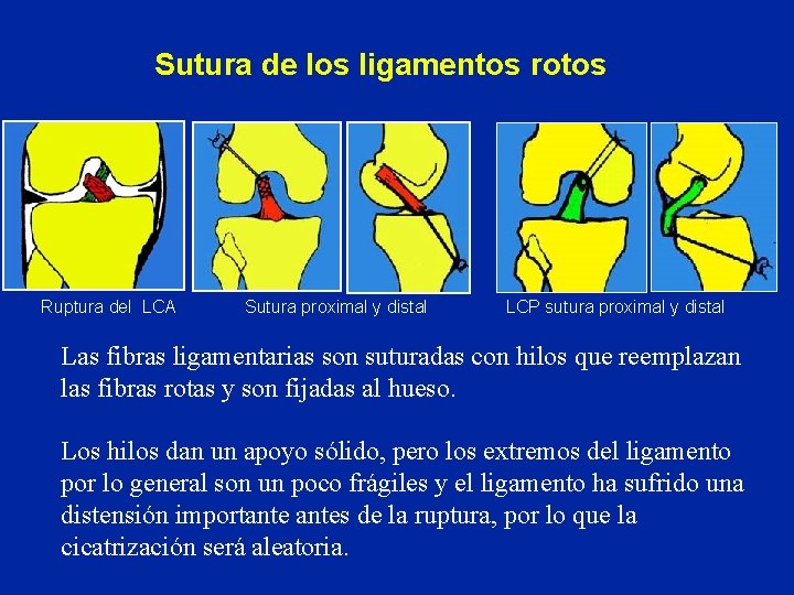 Sutura de los ligamentos rotos Ruptura del LCA Sutura proximal y distal LCP sutura