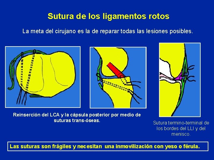 Sutura de los ligamentos rotos La meta del cirujano es la de reparar todas