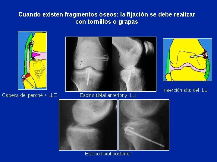 Cuando existen fragmentos óseos: la fijación se debe realizar con tornillos o grapas Cabeza