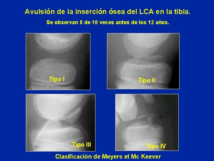 Avulsión de la inserción ósea del LCA en la tibia. Se observan 8 de