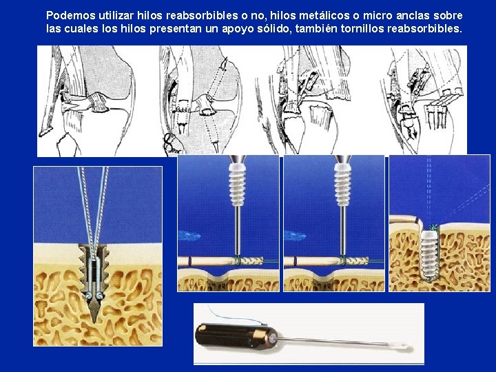 Podemos utilizar hilos reabsorbibles o no, hilos metálicos o micro anclas sobre las cuales