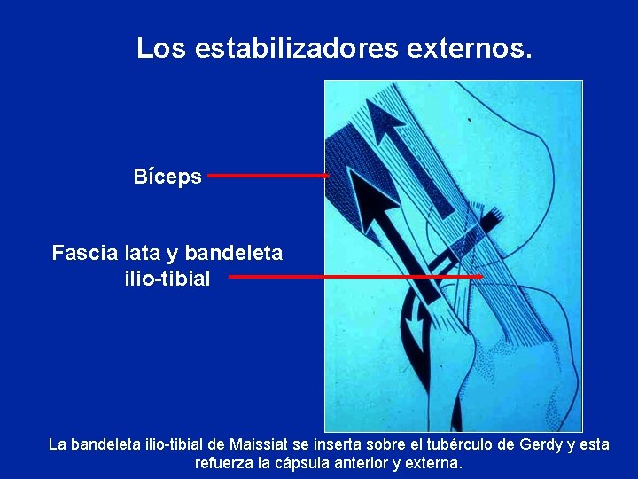 Los estabilizadores externos. Bíceps Fascia lata y bandeleta ilio-tibial La bandeleta ilio-tibial de Maissiat