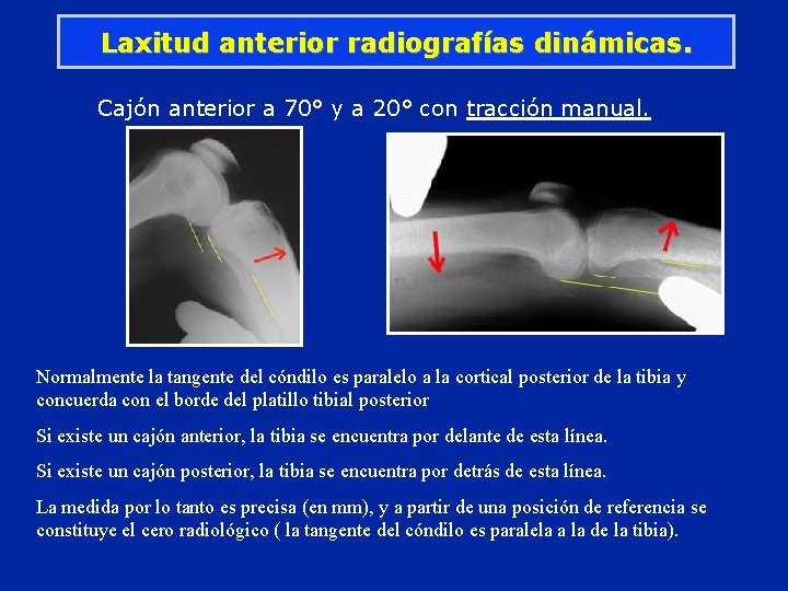 Laxitud anterior radiografías dinámicas. Cajón anterior a 70° y a 20° con tracción manual.
