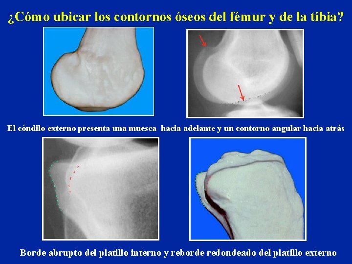 ¿Cómo ubicar los contornos óseos del fémur y de la tibia? El cóndilo externo