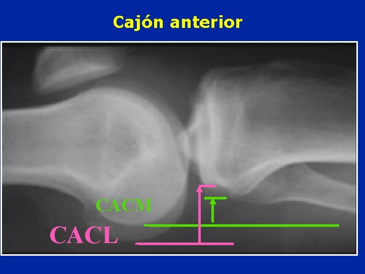 Cajón anterior CACM CACL 