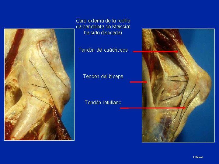 Cara externa de la rodilla (la bandeleta de Maissiat ha sido disecada) Tendón del