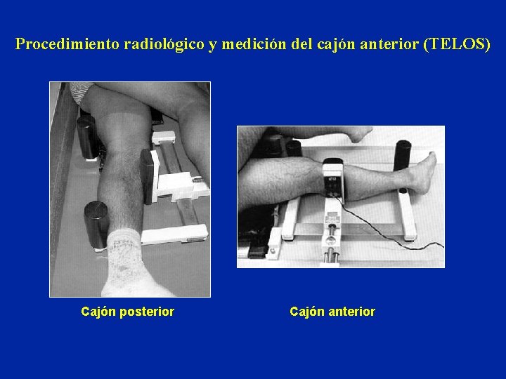 Procedimiento radiológico y medición del cajón anterior (TELOS) Cajón posterior Cajón anterior 