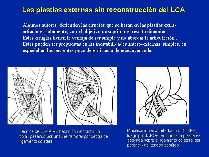 Las plastias externas sin reconstrucción del LCA Algunos autores defienden las cirugías que se