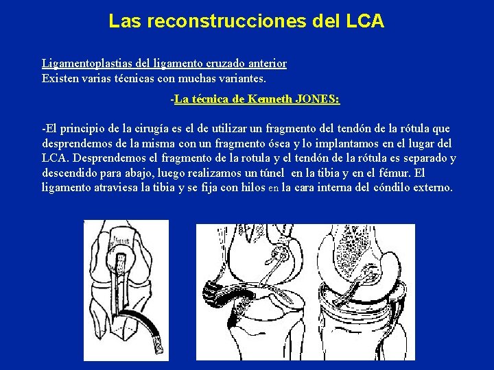 Las reconstrucciones del LCA Ligamentoplastias del ligamento cruzado anterior Existen varias técnicas con muchas