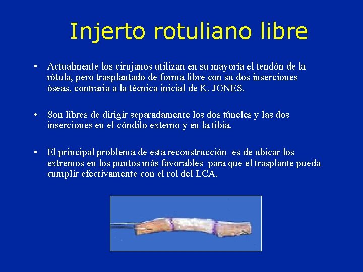 Injerto rotuliano libre • Actualmente los cirujanos utilizan en su mayoría el tendón de