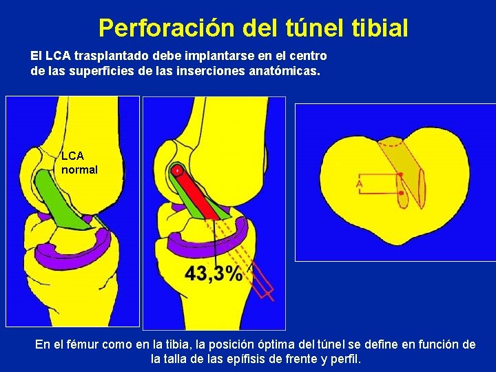 Perforación del túnel tibial El LCA trasplantado debe implantarse en el centro de las