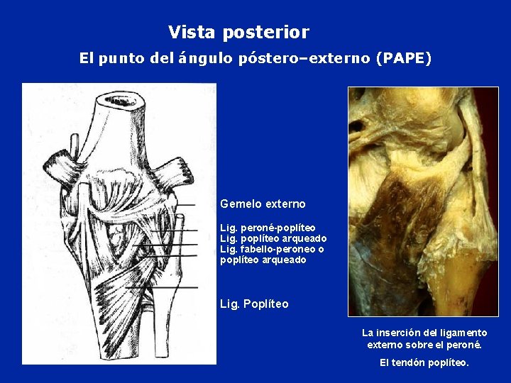 Vista posterior El punto del ángulo póstero–externo (PAPE) Gemelo externo Lig. peroné-poplíteo Lig. poplíteo