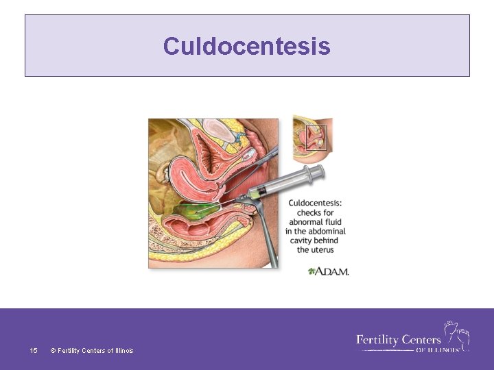 Culdocentesis 15 © Fertility Centers of Illinois 