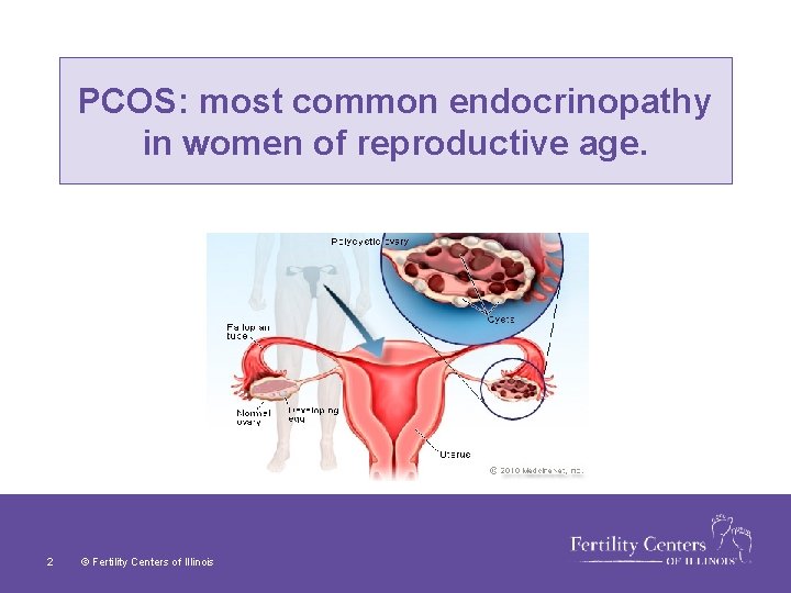 PCOS: most common endocrinopathy in women of reproductive age. 2 © Fertility Centers of