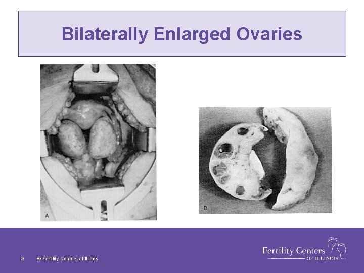 Bilaterally Enlarged Ovaries 3 © Fertility Centers of Illinois 