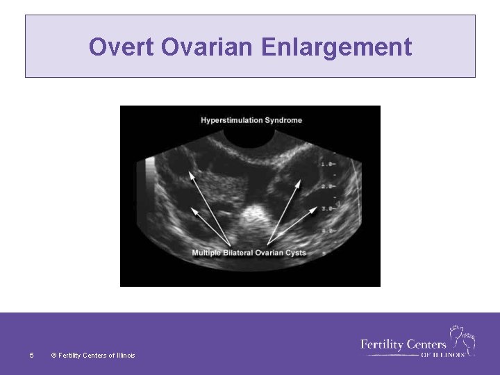 Overt Ovarian Enlargement 5 © Fertility Centers of Illinois 