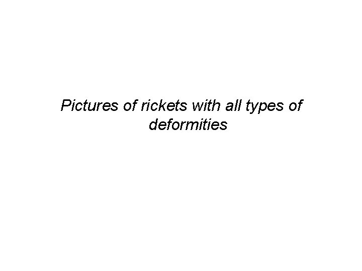 Pictures of rickets with all types of deformities 