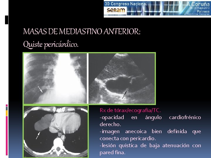 MASAS DE MEDIASTINO ANTERIOR: Quiste pericárdico. Rx de tórax/ecografía/TC. -opacidad en ángulo cardiofrénico derecho.