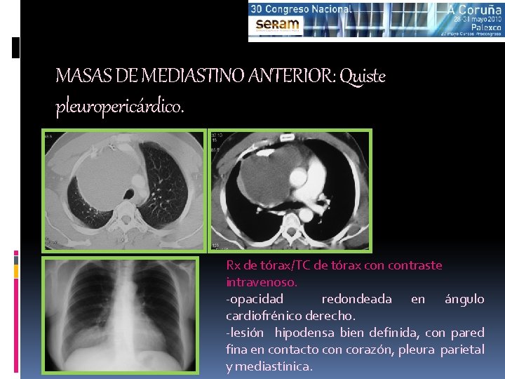 MASAS DE MEDIASTINO ANTERIOR: Quiste pleuropericárdico. Rx de tórax/TC de tórax contraste intravenoso. -opacidad