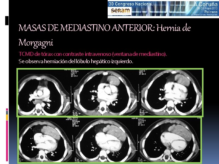 MASAS DE MEDIASTINO ANTERIOR: Hernia de Morgagni TCMD de tórax contraste intravenoso (ventana de