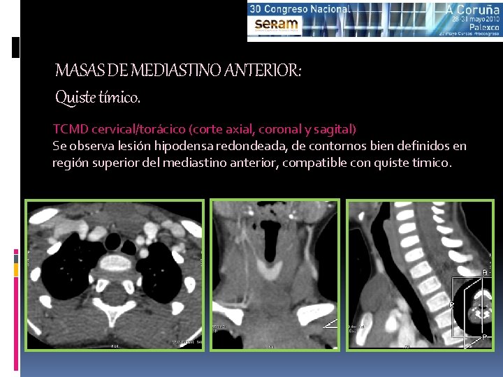 MASAS DE MEDIASTINO ANTERIOR: Quiste tímico. TCMD cervical/torácico (corte axial, coronal y sagital) Se