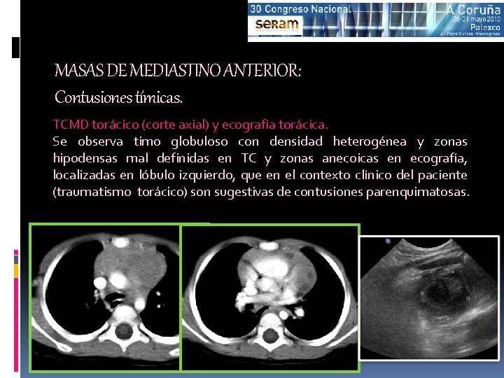 MASAS DE MEDIASTINO ANTERIOR: Contusiones tímicas. TCMD torácico (corte axial) y ecografía torácica. Se