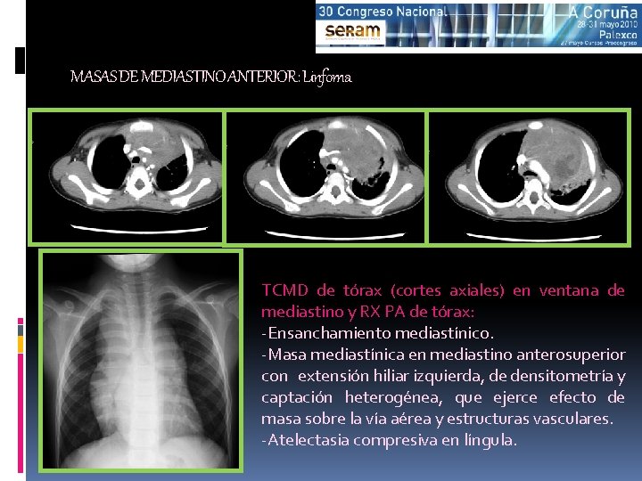 MASAS DE MEDIASTINO ANTERIOR: Linfoma TCMD de tórax (cortes axiales) en ventana de mediastino