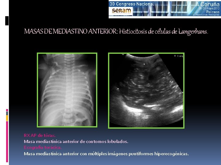 MASAS DE MEDIASTINO ANTERIOR: Histiocitosis de células de Langerhans. RX AP de tórax. Masa