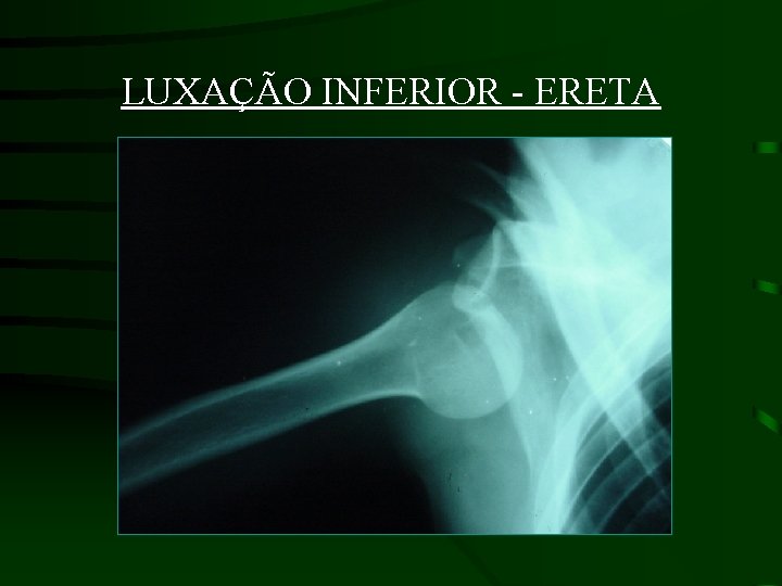 LUXAÇÃO INFERIOR - ERETA 