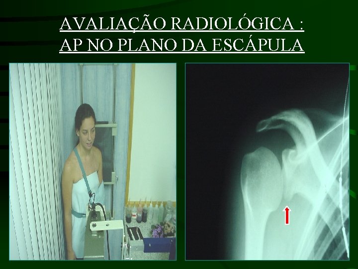 AVALIAÇÃO RADIOLÓGICA : AP NO PLANO DA ESCÁPULA 
