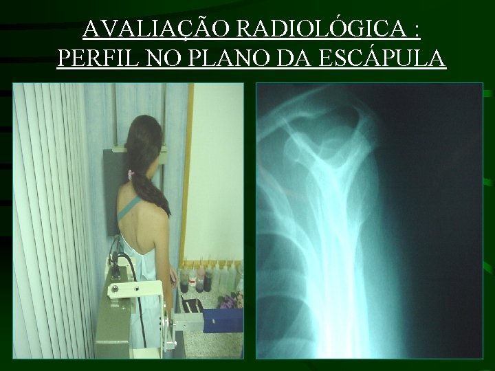 AVALIAÇÃO RADIOLÓGICA : PERFIL NO PLANO DA ESCÁPULA 
