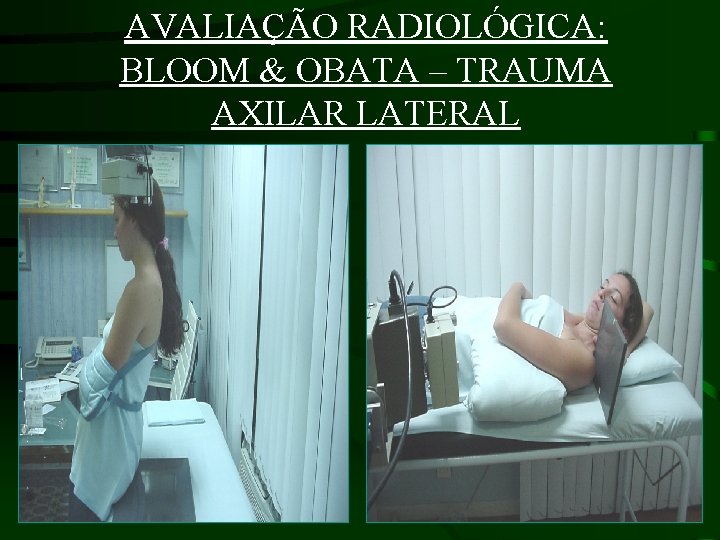 AVALIAÇÃO RADIOLÓGICA: BLOOM & OBATA – TRAUMA AXILAR LATERAL 