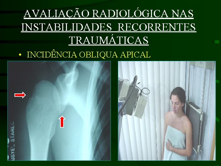 AVALIAÇÃO RADIOLÓGICA NAS INSTABILIDADES RECORRENTES TRAUMÁTICAS • INCIDÊNCIA OBLIQUA APICAL 