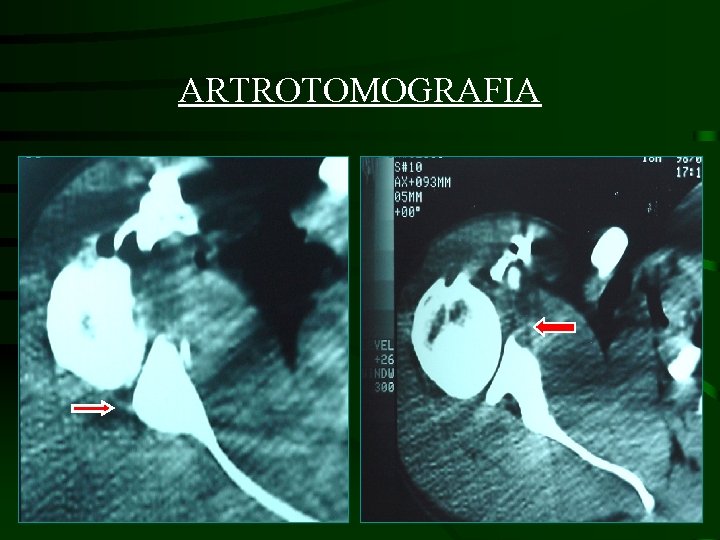ARTROTOMOGRAFIA • 