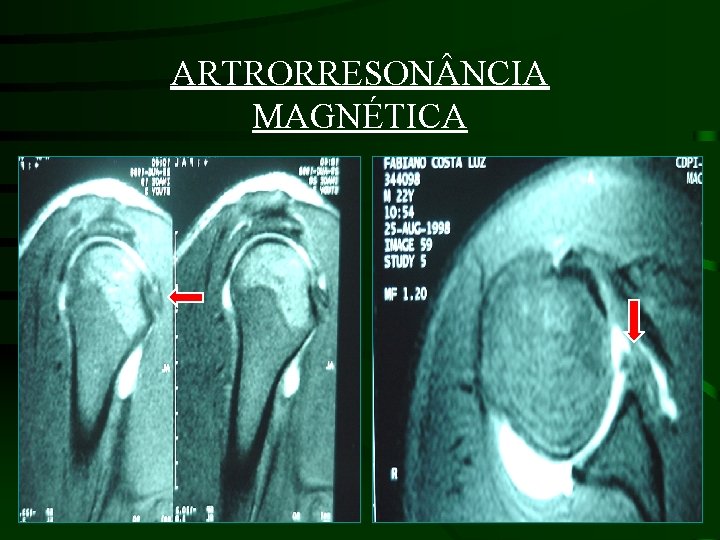 ARTRORRESON NCIA MAGNÉTICA • 