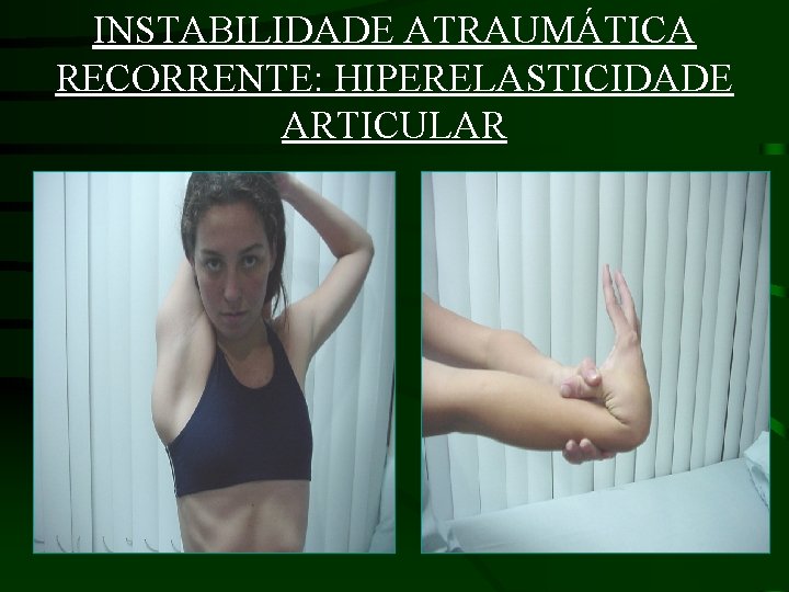 INSTABILIDADE ATRAUMÁTICA RECORRENTE: HIPERELASTICIDADE ARTICULAR 