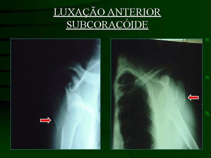 LUXAÇÃO ANTERIOR SUBCORACÓIDE 