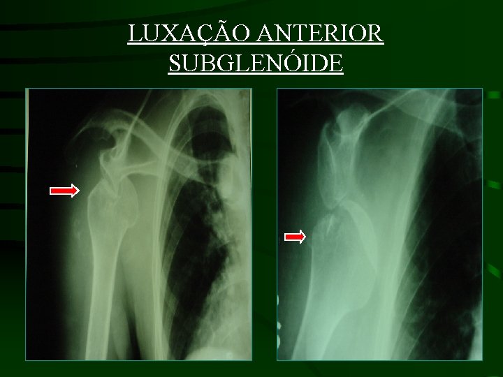 LUXAÇÃO ANTERIOR SUBGLENÓIDE 
