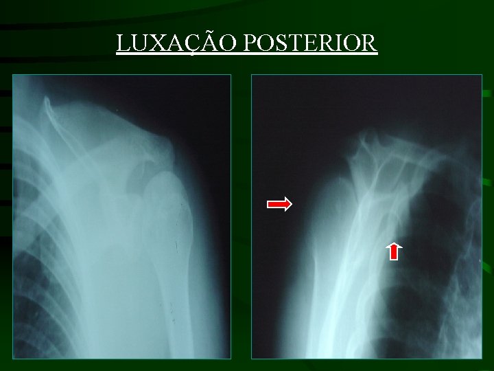 LUXAÇÃO POSTERIOR 