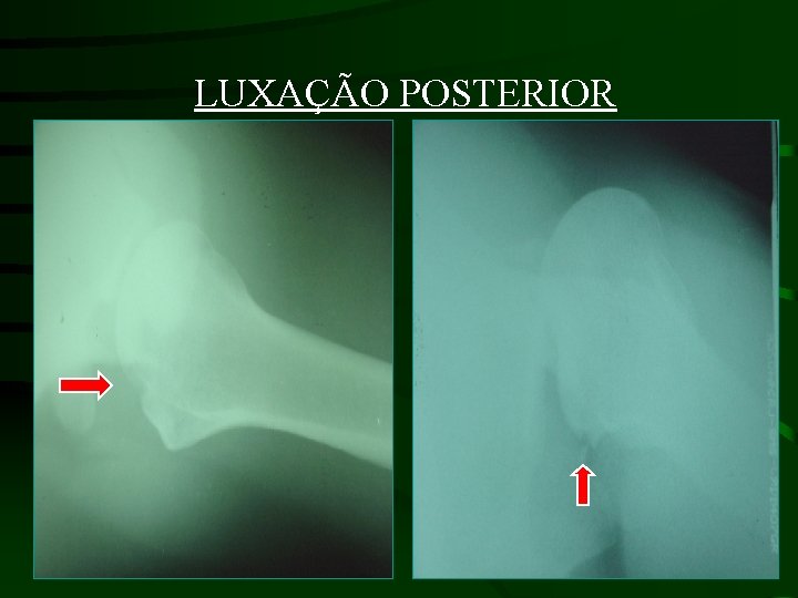 LUXAÇÃO POSTERIOR 